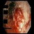 En la úlcera duodenal no parece imprescindible investigar la presencia de la infección
