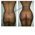 Lipoescultura O Plastic Surgery Masaje Drenaje Linfatico o Lymphatic Drainage Massage Recomendaciones Salud Y Belleza LLC Gloria Arenas