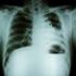 Valoración de metástasis cerebrales de carcinoma pulmonar mediante PET-RM como guía terapéutica