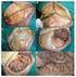 Descripción de la anatomía quirúrgica del hueso temporal y el foramen yugular. Oscar Hernando Ramírez Moreno