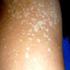 Las micosis superficiales son infecciones de piel y/o