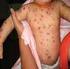 Seroprevalencia de anticuerpos para varicela en una población de mujeres embarazadas de la ciudad de Córdoba, Argentina