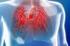 La hipertensión pulmonar
