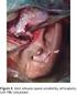 Reporte de caso. Case report. Anquilosis bilateral de Articulación Temporomandibular asociada a trauma