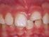 Traumas dentoalveolares relacionados con maloclusiones en menores de 15 años