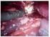 Manejo laparoscópico de catéter JJ calcificado en paciente con púrpura trombocitopénica
