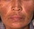 El melasma, conocido también como cloasma, paño o máscara del. embarazo, es un trastorno de la pigmentación de la piel que altera su estética, de