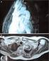 Fístula aortobronquial por aneurisma de aorta: tratamiento endovascular