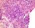 Tumores de células germinales extragonadales con fenómenos burned out en testículos