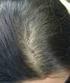 Alopecia androgénica femenina: nuevos factores fisiopatológicos y futuras tendencias para un abordaje clínico más integral