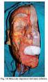 Revisión anatómica del nervio facial (VII Par Craneano)
