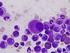 Ibrutinib en Leucemia Linfática Crónica, Linfoma de células del Manto y Macroglobulinemia de Waldeström INFORME CFT- HOSPITAL REINA SOFÍA CÓRDOBA