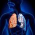 La enfermedad pulmonar obstructiva crónica