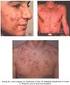 Trastornos del folículo pilosebáceo: acné y rosácea