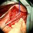 Lesión de la arteria axilar como complicación de una fractura luxación de cuello de húmero