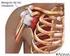 Lesiones del Manguito Rotatorio