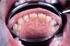 Erosión dental por vómitos de repetición.