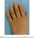 Articulaciones interfalángicas distales. Situación: Miembro inferior (dedos) Huesos que la componen: Falanges medias y falanges distales