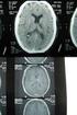 Características tomográficas de la enfermedad cerebrovascular isquémica