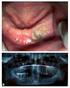 Osteonecrosis maxilar por bifosfonatos. presentación de un caso clínico. Medidas preventivas