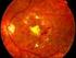 Cribado fotográfico de retinopatía diabética
