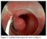 Ligadura endoscópica de várices esofágicas más propranolol para profilaxis secundaria del sangrado digestivo en pacientes cirróticos