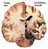 Enfermedad degenerativa del SNC. Alzheimer. Trastorno progresivo movimientos musculares 80% Afecta 1% población > 65 años