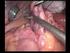 Anastomosis intestinal: manual o mecánica?, en un plano o en dos planos?