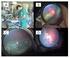 Tratamiento con láser diodo en la retinopatía del prematuro: con más de una década de experiencia.