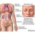 5. Manejo general del lupus eritematoso sistémico