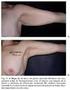 Nuestra experiencia en la mamoplastia con cicatriz vertical