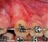 Reporte de caso: Tracción orto quirúrgico de canino maxilar retenido