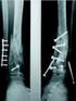 Resultados del tratamiento quirúrgico de las fracturas complejas del pilón tibial