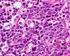 El linfoma difuso de células B grandes representa