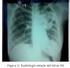 Tuberculosis pulmonar. Screening radiológico.