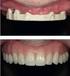 Peek, alternativa a aleaciones metálicas en la boca. Odontología sin metal
