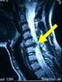 Hernias discales cervicales