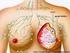 El cáncer de mama es una enfermedad en la que las células cancerosas se multiplican en el tejido mamario.