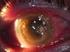 Absceso corneal tras colocación de anillo intraestromal: una complicación inusual?