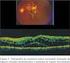Edema quístico macular diagnosticado por tomografía de coherencia óptica en pacientes operados de catarata