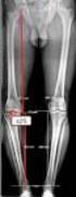 Osteotomía valguizante de tibia en el tratamiento de la gonartrosis