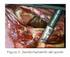 Presentación de un caso de quiste hepático simple tratado por cirugía mínima invasiva