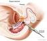 Biopsia De Prostata Informacion y Instrucciones