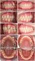 La asimetría en el adolescente: la clase II asimétrica Interés del anclaje mandibular en la armonización de los maxilares
