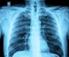 Manifestaciones radiográficas de las atelectasias pulmonares lobares en la radiografía de tórax y su correlación con la tomografía computarizada