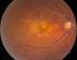Desprendimiento primario de la retina: cerclaje escleral o vitrectomía pars plana?