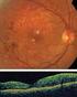 Bevacizumab (Avastin) intravítreo en edema macular secundario a oclusión de vena central de la retina