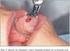 Biopsia incisional versus biopsia escisional para el diagnóstico y la estadificación del melanoma cutáneo