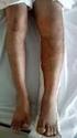 Fracturas de rodilla: compromiso de los platillos tibiales, estudio clínico y experimental*