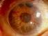Glaucoma neovascular, complicación de la isquemia retiniana